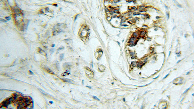 Immunohistochemical of paraffin-embedded human breast cancer using Catalog No:111934(BAIAP2 antibody) at dilution of 1:100 (under 10x lens)
