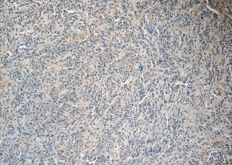 Immunohistochemistry of paraffin-embedded human gliomas tissue slide using Catalog No:107343(NUMBLIKE Antibody) at dilution of 1:50 (under 10x lens)