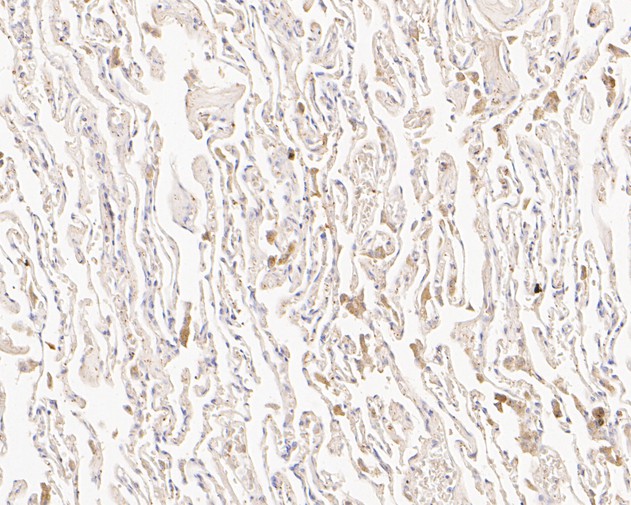 Fig2:; Immunohistochemical analysis of paraffin-embedded human lung tissue using anti-SLFN12 antibody. The section was pre-treated using heat mediated antigen retrieval with Tris-EDTA buffer (pH 8.0-8.4) for 20 minutes.The tissues were blocked in 5% BSA for 30 minutes at room temperature, washed with ddH; 2; O and PBS, and then probed with the primary antibody ( 1/200) for 30 minutes at room temperature. The detection was performed using an HRP conjugated compact polymer system. DAB was used as the chromogen. Tissues were counterstained with hematoxylin and mounted with DPX.