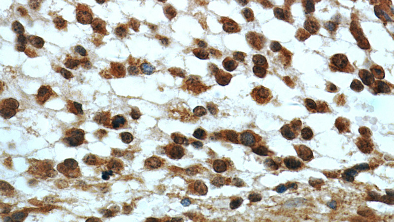 Immunohistochemical of paraffin-embedded human gliomas using Catalog No:107424(MGEA5 antibody) at dilution of 1:50 (under 40x lens)