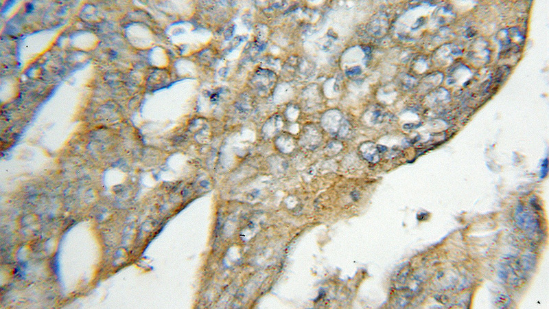 Immunohistochemical of paraffin-embedded human colon cancer using Catalog No:113393(NT5C3 antibody) at dilution of 1:50 (under 10x lens)