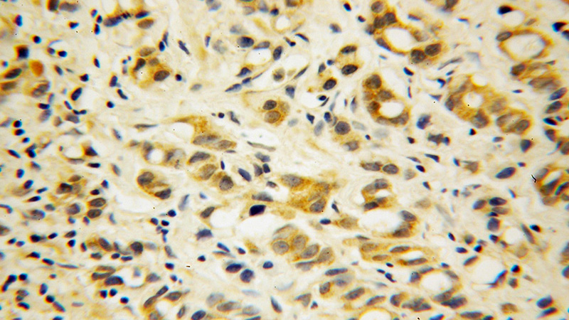 Immunohistochemical of paraffin-embedded human gliomas using Catalog No:113476(PABPC4 antibody) at dilution of 1:50 (under 40x lens)