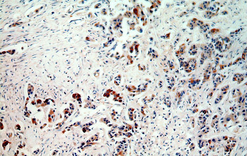 Immunohistochemical of paraffin-embedded human breast cancer using Catalog No:110636(FGF8 antibody) at dilution of 1:50 (under 10x lens)