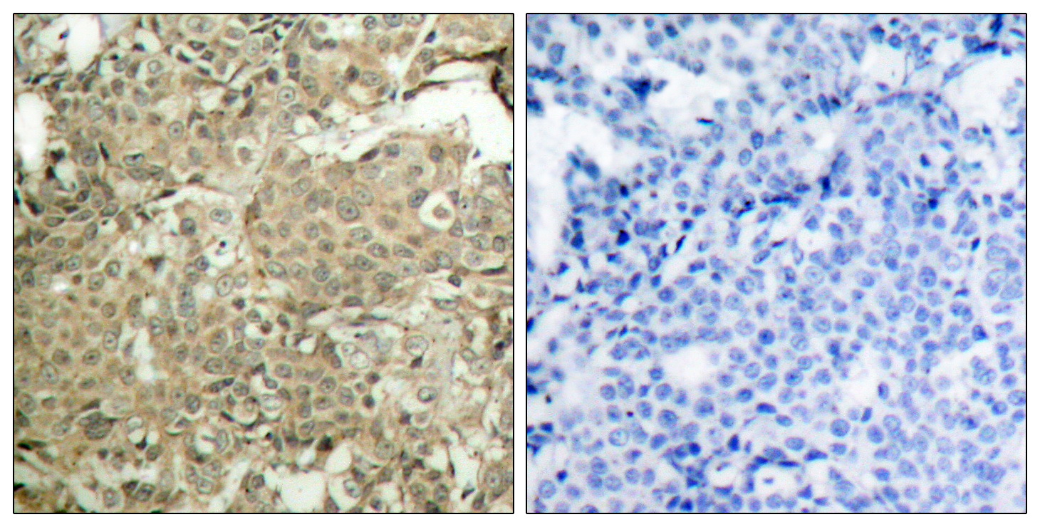 Immunohistochemical analysis of paraffin-embedded human breast carcinoma tissue using cofilin (Phospho-Ser3) Antibody  (left) or the same antibody preincubated with blocking peptide (right).