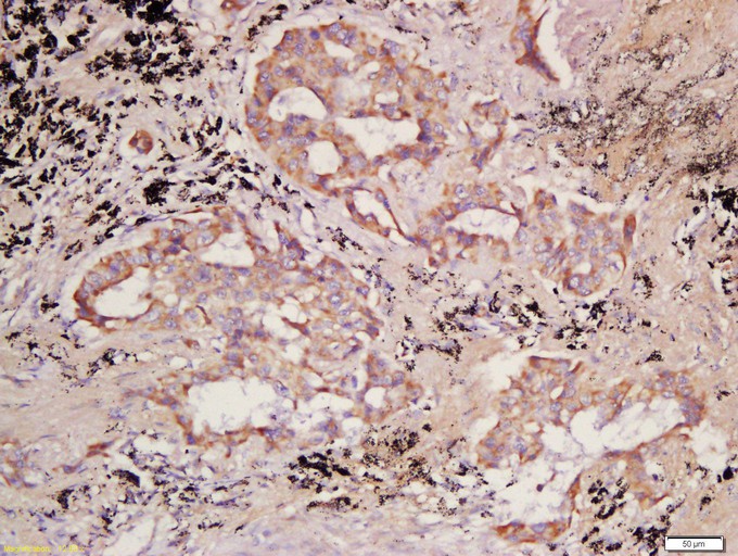 Fig3: Tissue/cell: human lung carcinoma; 4% Paraformaldehyde-fixed and paraffin-embedded;; Antigen retrieval: citrate buffer ( 0.01M, pH 6.0 ), Boiling bathing for 15min; Block endogenous peroxidase by 3% Hydrogen peroxide for 30min; Blocking buffer (normal goat serum,C-0005) at 37℃ for 20 min;; Incubation: Anti-PCDHB10 Polyclonal Antibody, Unconjugated 1:200, overnight at 4℃, followed by conjugation to the secondary antibody(SP-0023) and DAB(C-0010) staining