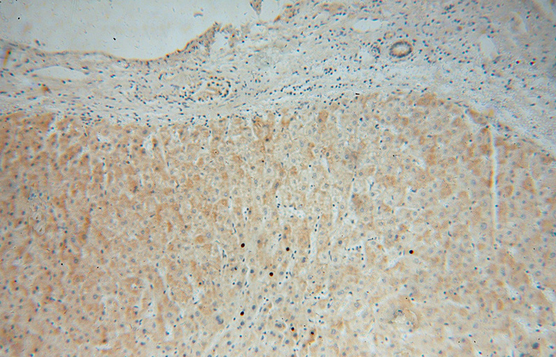 Immunohistochemical of paraffin-embedded human liver cancer using Catalog No:112824(MRPL34 antibody) at dilution of 1:100 (under 10x lens)