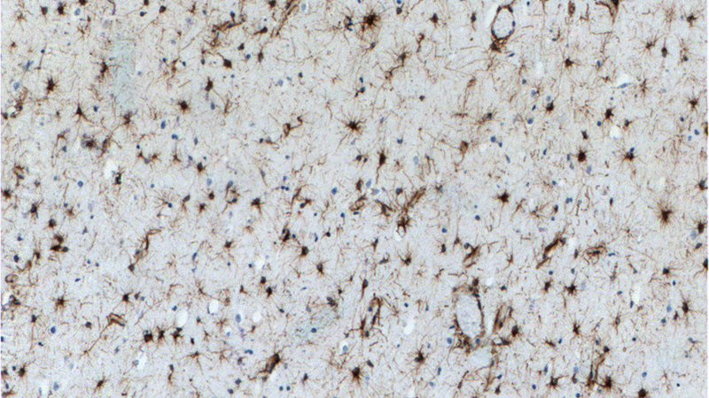 Immunohistochemistry of paraffin-embedded human brain tissue slide using Catalog No:110945(GFAP Antibody) at dilution of 1:2000 (under 10x lens).