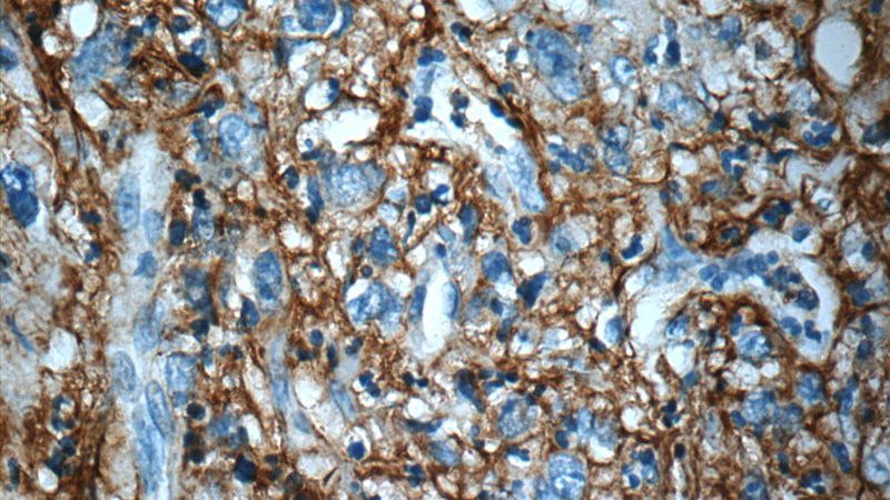 Immunohistochemistry of paraffin-embedded human stomach cancer slide using Catalog No:111948(ITIH3 Antibody) at dilution of 1:50