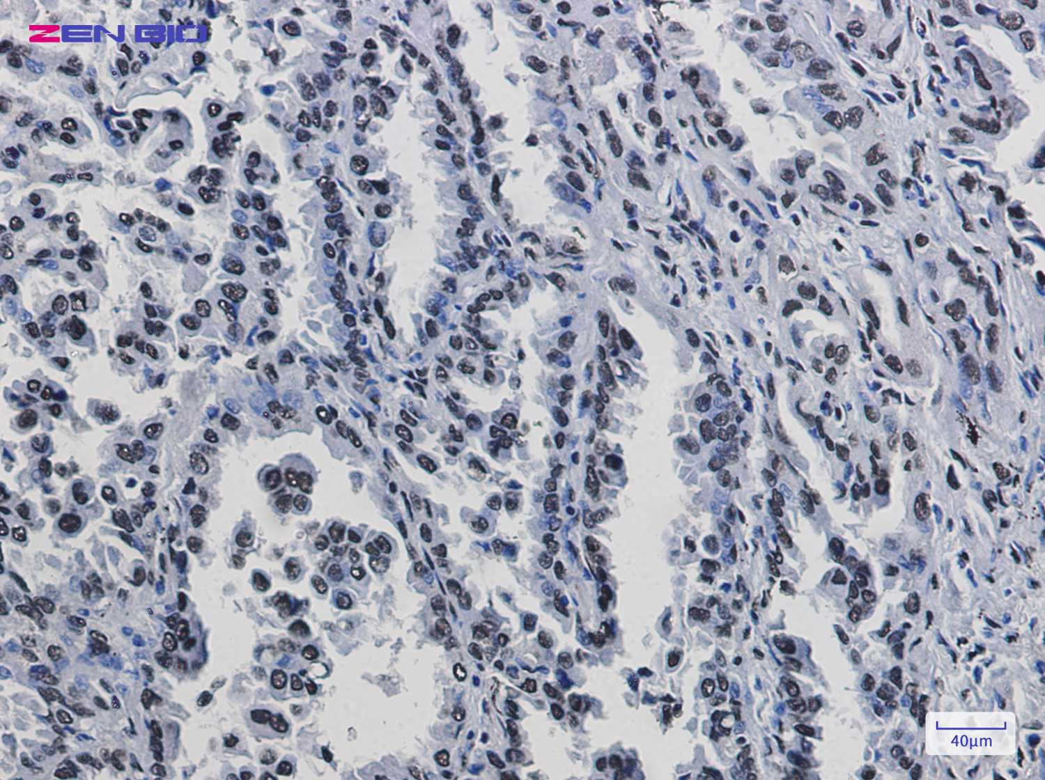 Immunohistochemistry of KAP1 in paraffin-embedded Human lung cancer tissue using KAP1 Rabbit pAb at dilution 1/50
