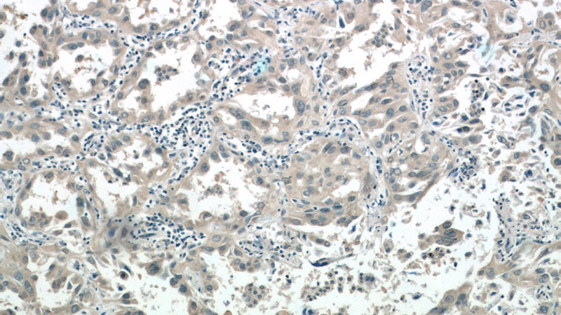 Immunohistochemistry of paraffin-embedded human lung cancer tissue slide using Catalog No:107969(ALDH3B1 Antibody) at dilution of 1:50 (under 10x lens)