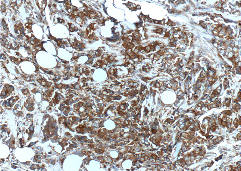 Immunohistochemistry of paraffin-embedded human breast cancer tissue slide using Catalog No:114961(S100A4 Antibody) at dilution of 1:200 (under 10x lens).