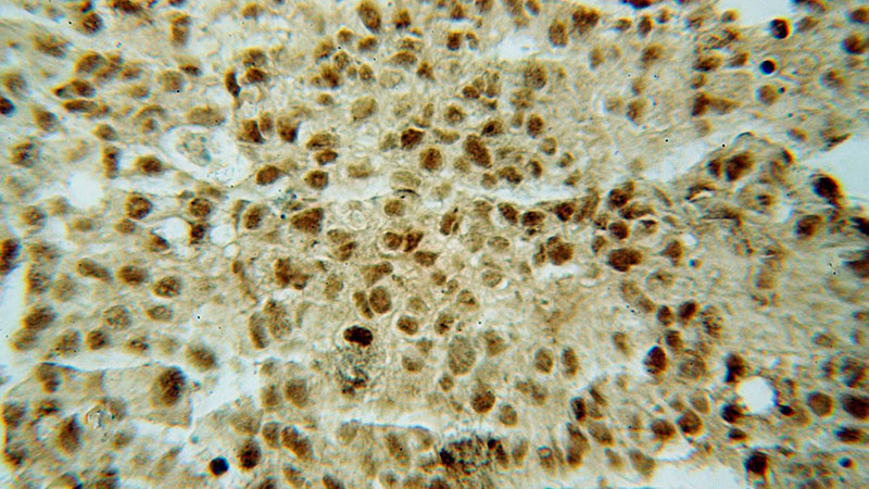 Immunohistochemical of paraffin-embedded human colon cancer using Catalog No:113429(OSBPL10 antibody) at dilution of 1:50 (under 40x lens)