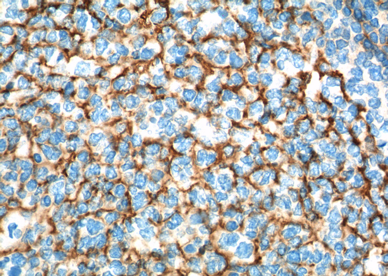 Immunohistochemistry of paraffin-embedded human tonsillitis tissue slide using Catalog No:107125(CD23,FCER2 Antibody) at dilution of 1:200 (under 40x lens). heat mediated antigen retrieved with Tris-EDTA buffer(pH9).