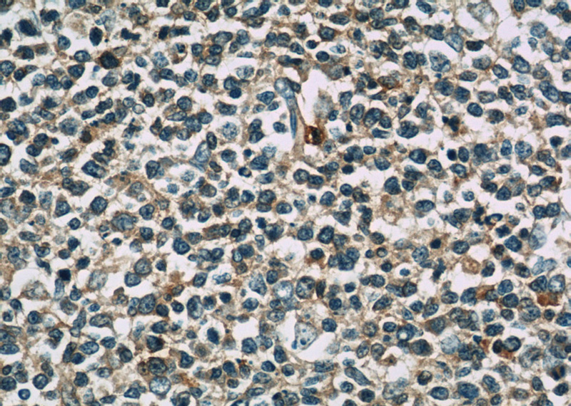 Immunohistochemistry of paraffin-embedded human tonsillitis slide using Catalog No:116287(TNFAIP8 Antibody) at dilution of 1:50