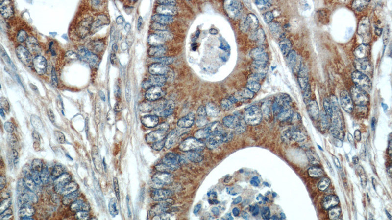 Immunohistochemical of paraffin-embedded human colon cancer using Catalog No:112119(KRAS antibody) at dilution of 1:50 (under 40x lens)