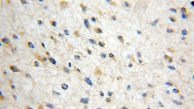 Immunohistochemical of paraffin-embedded human gliomas using Catalog No:117111(BCS1L antibody) at dilution of 1:50 (under 10x lens)