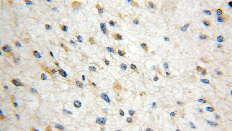 Immunohistochemical of paraffin-embedded human gliomas using Catalog No:117111(BCS1L antibody) at dilution of 1:50 (under 10x lens)
