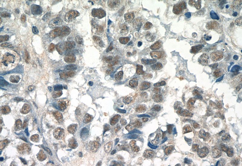 Immunohistochemistry of paraffin-embedded human breast cancer tissue slide using Catalog No:115221(SETD1B Antibody) at dilution of 1:50 (under 40x lens)