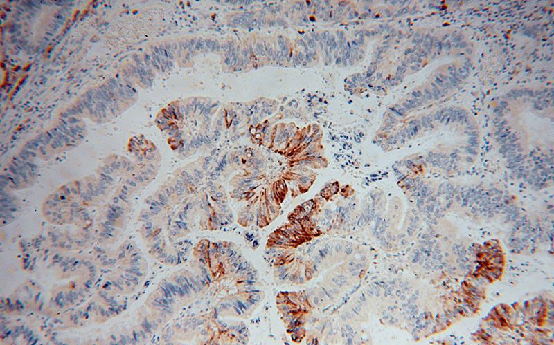 Immunohistochemical of paraffin-embedded human colon cancer using Catalog No:111604(IDH2 antibody) at dilution of 1:50 (under 10x lens)