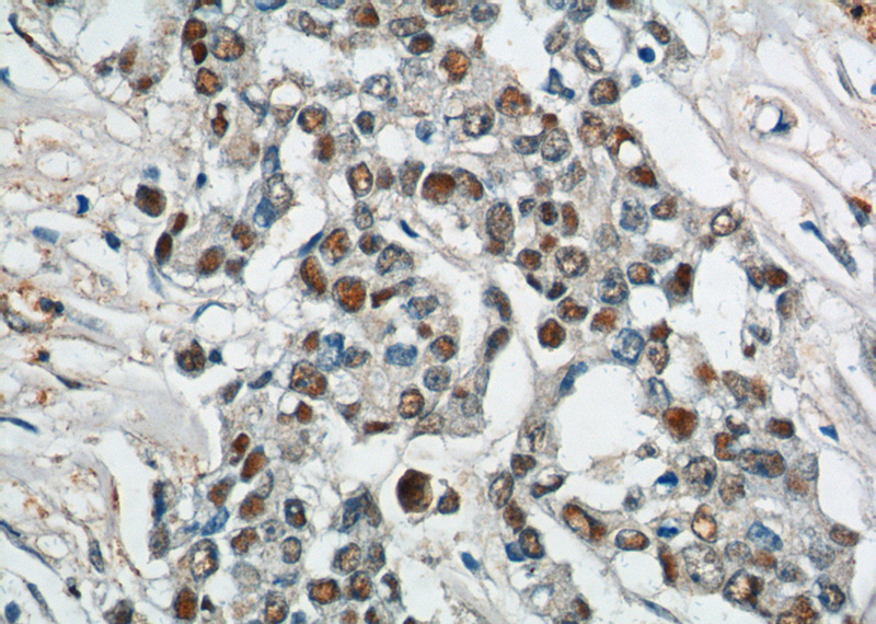 Immunohistochemistry of paraffin-embedded human colon cancer tissue slide using Catalog No:115042(SAE1 Antibody) at dilution of 1:200 (under 40x lens).