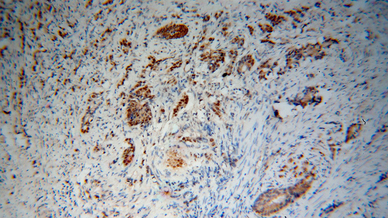 Immunohistochemical of paraffin-embedded human gliomas using Catalog No:113986(PNRC2 antibody) at dilution of 1:50 (under 10x lens)