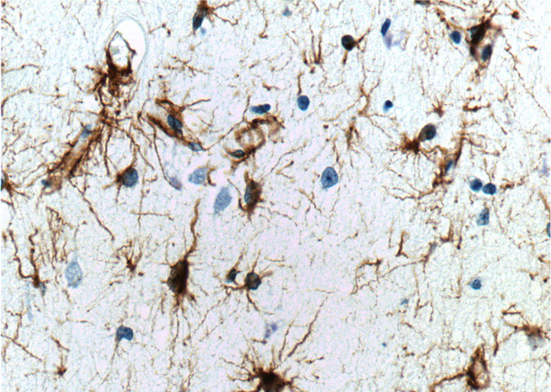 Immunohistochemistry of paraffin-embedded human brain tissue slide using Catalog No:110945(GFAP Antibody) at dilution of 1:2000 (under 40x lens).
