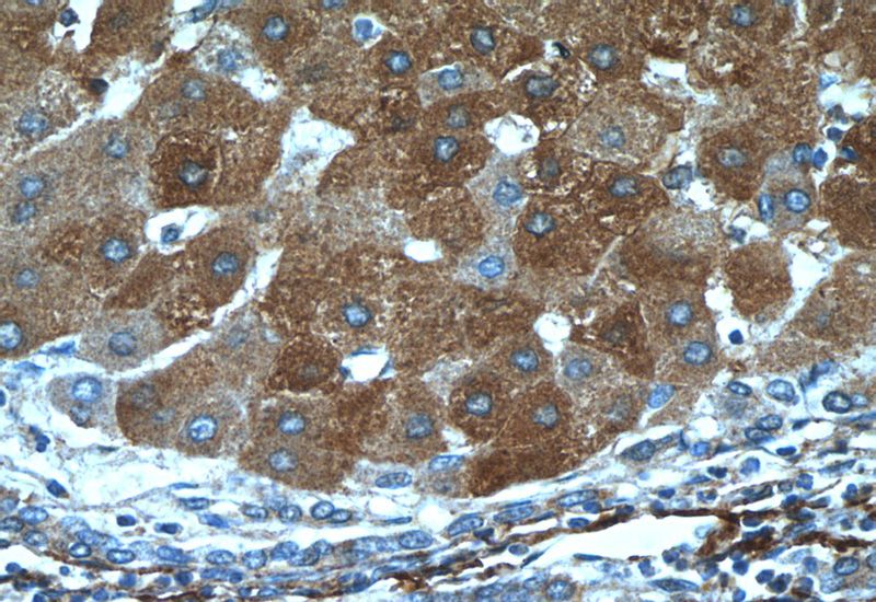 Immunohistochemistry of paraffin-embedded human hepatocirrhosis tissue slide using Catalog No:116760(VTN Antibody) at dilution of 1:50 (under 40x lens)