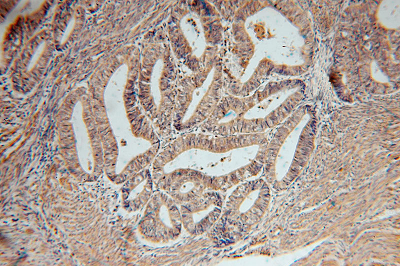 Immunohistochemical of paraffin-embedded human endometrial cancer using Catalog No:115203(SERPINB2 antibody) at dilution of 1:50 (under 10x lens)