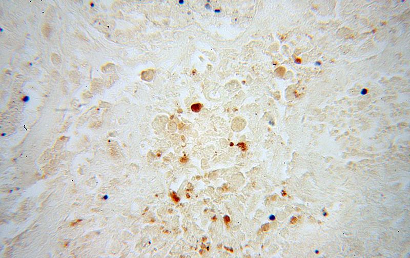 Immunohistochemical of paraffin-embedded human osteosarcoma using Catalog No:117146(BIN1 antibody) at dilution of 1:100 (under 40x lens)