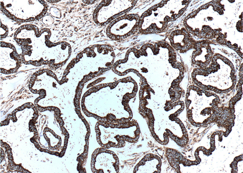 Immunohistochemistry of paraffin-embedded human ovary tumor tissue slide using Catalog No:107266(HSPD1 Antibody) at dilution of 1:500 (under 10x lens). heat mediated antigen retrieved with Tris-EDTA buffer(pH9).