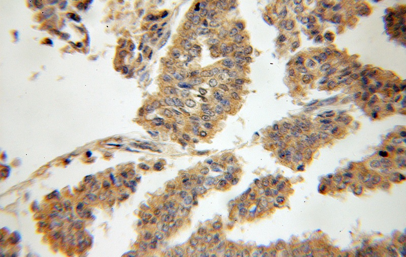 Immunohistochemical of paraffin-embedded human breast cancer using Catalog No:107684(ABCB6 antibody) at dilution of 1:50 (under 10x lens)
