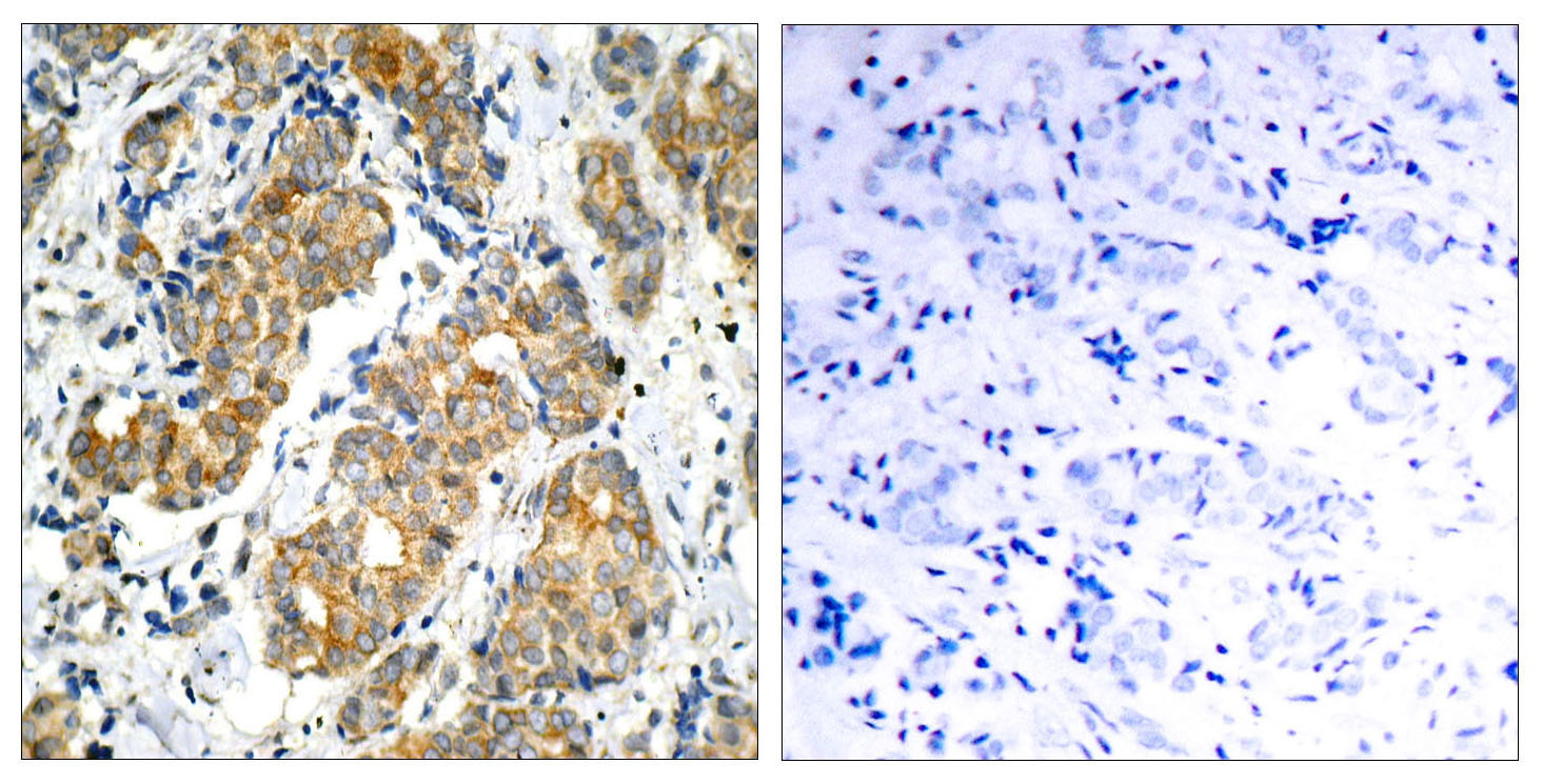 Immunohistochemical analysis of paraffin-embedded human breast carcinoma tissue using GSK3u03b1 (Ab-21) Antibody (left) or the same antibody preincubated with blocking peptide (right).