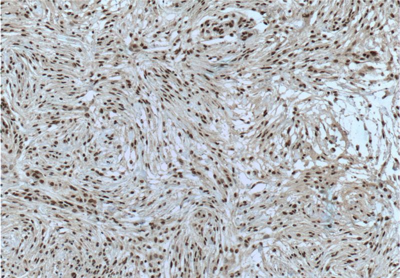 Immunohistochemistry of paraffin-embedded human meningioma tissue slide using Catalog No:107424(MGEA5 Antibody) at dilution of 1:200 (under 10x lens). Heat mediated antigen retrieved with Citric acid buffer, pH6.0.