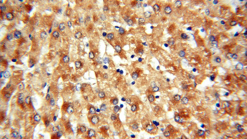 Immunohistochemical of paraffin-embedded human liver using Catalog No:107728(ACAT2 antibody) at dilution of 1:100 (under 40x lens)