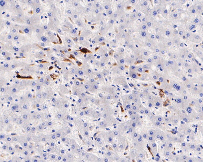 Fig4:; Immunohistochemical analysis of paraffin-embedded human liver tissue using anti-CD68 antibody. The section was pre-treated using heat mediated antigen retrieval with Tris-EDTA buffer (pH 8.0-8.4) for 20 minutes.The tissues were blocked in 5% BSA for 30 minutes at room temperature, washed with ddH; 2; O and PBS, and then probed with the primary antibody ( 1/200) for 30 minutes at room temperature. The detection was performed using an HRP conjugated compact polymer system. DAB was used as the chromogen. Tissues were counterstained with hematoxylin and mounted with DPX.