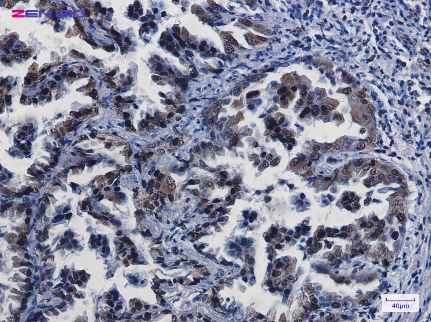 Immunohistochemistry of CREB in paraffin-embedded Human lung cancer tissue using CREB Rabbit pAb at dilution 1/20