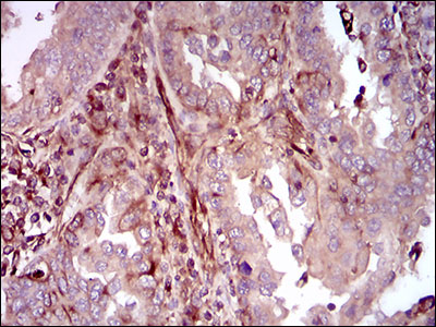 Immunohistochemical analysis of paraffin-embedded endometrial cancer tissues using MAPK14 mouse mAb with DAB staining.