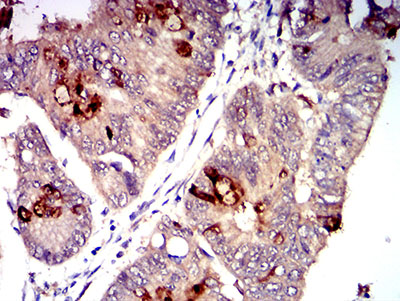 Fig3: Immunohistochemical analysis of paraffin-embedded rectum cancer tissues using anti-CD1C antibody. The section was pre-treated using heat mediated antigen retrieval with Tris-EDTA buffer (pH 8.0) for 20 minutes. The tissues were blocked in 5% BSA for 30 minutes at room temperature, washed with ddH2O and PBS, and then probed with the primary antibody ( 1/100) for 30 minutes at room temperature. The detection was performed using an HRP conjugated compact polymer system. DAB was used as the chromogen. Tissues were counterstained with hematoxylin and mounted with DPX.