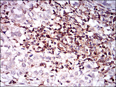 Fig6: Immunohistochemical analysis of paraffin-embedded human bladder cancer tissue using anti-CD68 antibody. Counter stained with hematoxylin.