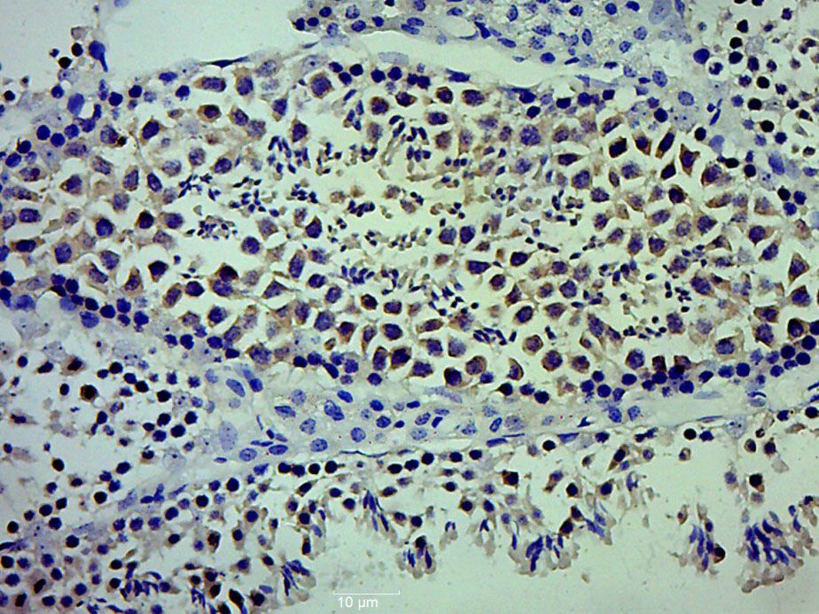 Fig1: Paraformaldehyde-fixed, paraffin embedded (Mouse testis); Antigen retrieval by boiling in sodium citrate buffer (pH6.0) for 15min; Block endogenous peroxidase by 3% hydrogen peroxide for 20 minutes; Blocking buffer (normal goat serum) at 37℃ for 30min; Antibody incubation with (LCN8) Polyclonal Antibody, Unconjugated at 1:500 overnight at 4℃, followed by a conjugated secondary (sp-0023) for 20 minutes and DAB staining.