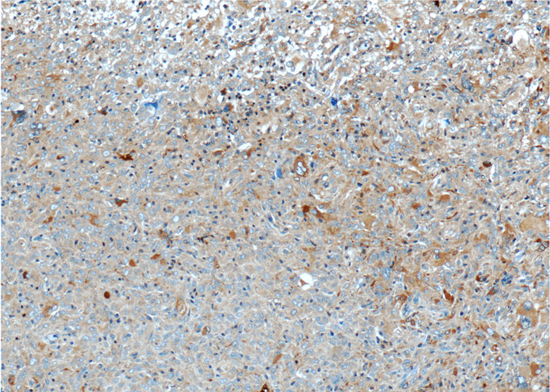 Immunohistochemistry of paraffin-embedded human gliomas tissue slide using Catalog No:113925(PLA2G4B Antibody) at dilution of 1:50 (under 10x lens)