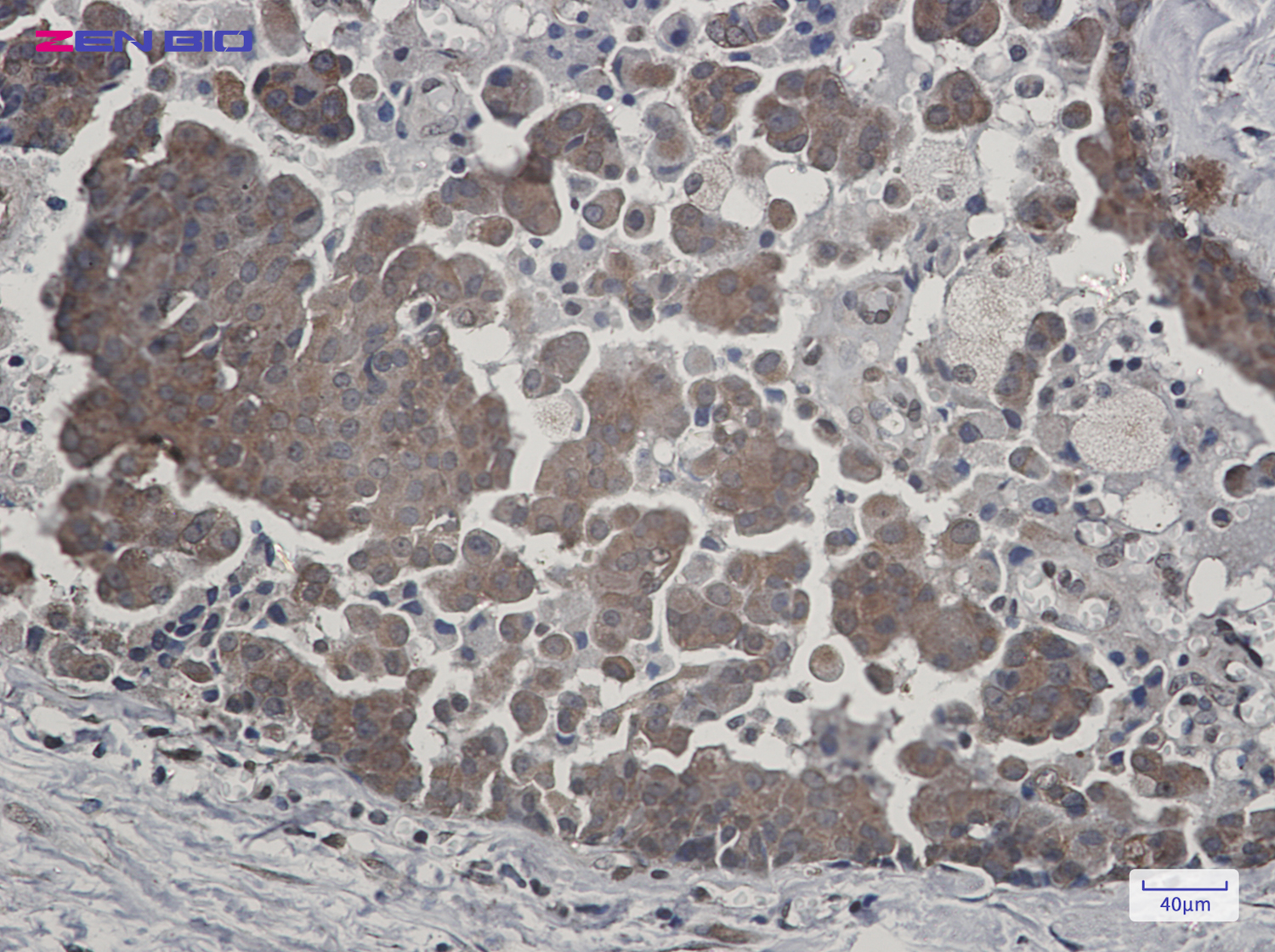Immunohistochemistry of Cytochrome P450 Reductase in paraffin-embedded Human breast cancer tissue using Cytochrome P450 Reductase Rabbit pAb at dilution 1/20