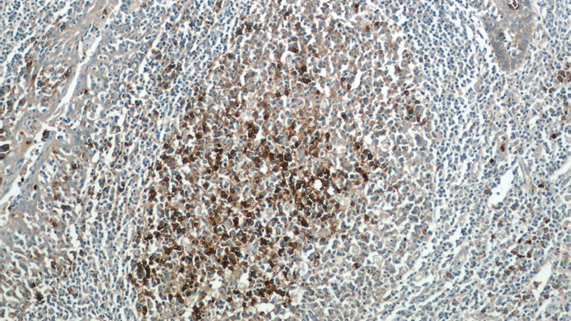 Immunohistochemistry of paraffin-embedded human tonsillitis tissue slide using Catalog No:109033(CD38 Antibody) at dilution of 1:50 (under 10x lens)