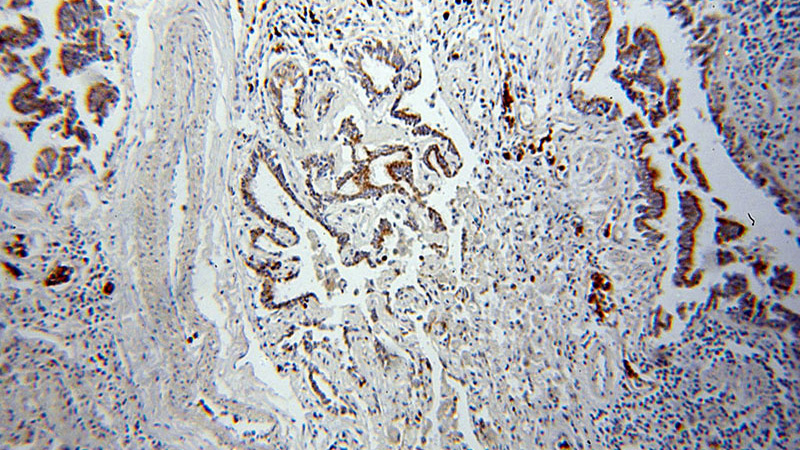 Immunohistochemical of paraffin-embedded human lung cancer using Catalog No:107411(MAGEA3 antibody) at dilution of 1:50 (under 10x lens)