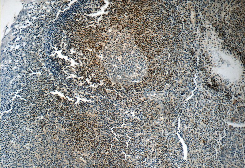 Immunohistochemistry of paraffin-embedded human tonsillitis tissue slide using Catalog No:108391(BCL2 Antibody) at dilution of 1:50 (under 10x lens)