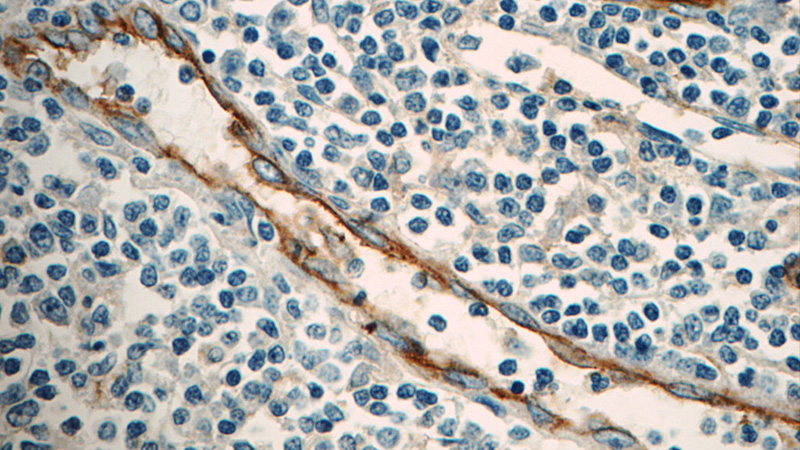 Immunohistochemistry of paraffin-embedded human tonsillitis tissue slide using Catalog No:107272(ICAM-1 Antibody) at dilution of 1:50 (under 40x lens)