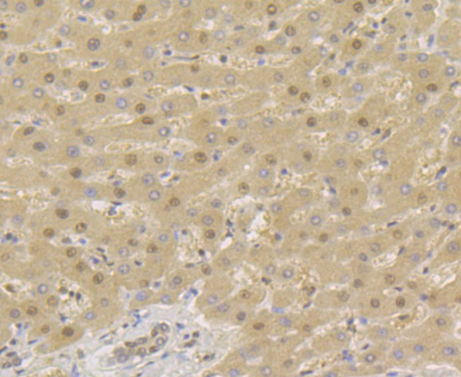 Fig5:; Immunohistochemical analysis of paraffin-embedded human liver carcinoma tissue using anti-TNPO3 antibody. The section was pre-treated using heat mediated antigen retrieval with sodium citrate buffer (pH 6.0) for 20 minutes. The tissues were blocked in 5% BSA for 30 minutes at room temperature, washed with ddH; 2; O and PBS, and then probed with the primary antibody ( 1/50) for 30 minutes at room temperature. The detection was performed using an HRP conjugated compact polymer system. DAB was used as the chromogen. Tissues were counterstained with hematoxylin and mounted with DPX.