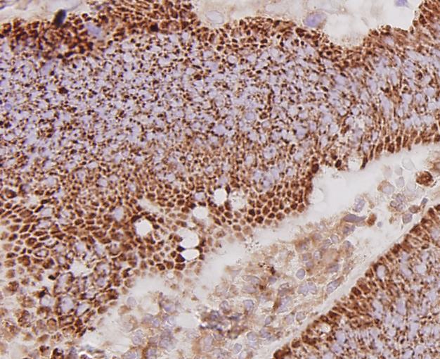 Fig7: Immunohistochemical analysis of paraffin-embedded human colon cancer tissue using anti-cMet antibody. Counter stained with hematoxylin.