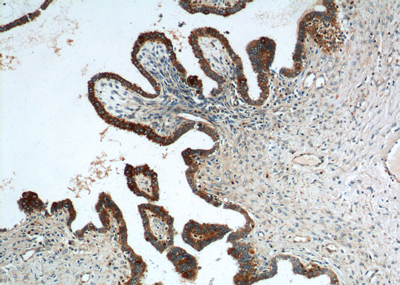 Immunohistochemistry of paraffin-embedded human ovary tumor tissue slide using Catalog No:109810(CK7 Antibody) at dilution of 1:200 (under 10x lens).
