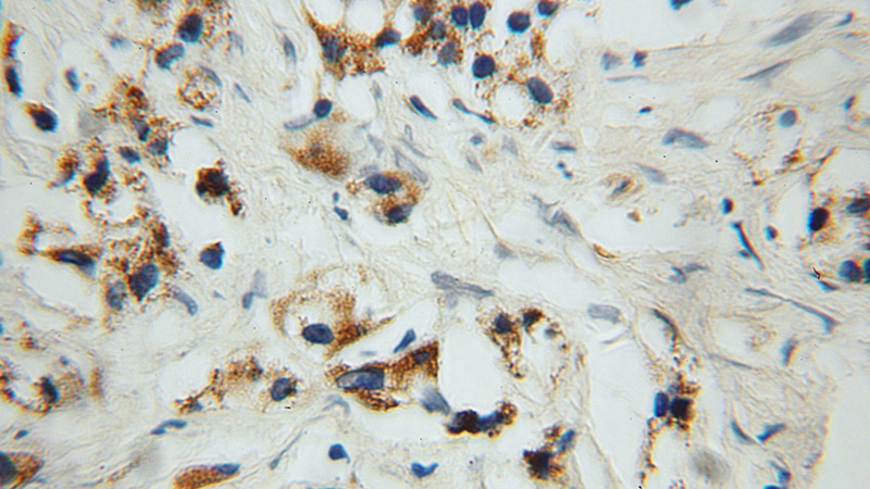 Immunohistochemical of paraffin-embedded human prostate cancer using Catalog No:114352(PYCR1 antibody) at dilution of 1:100 (under 10x lens)
